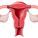 Illustration for article titled Procedure to Remove Fibroids Might Actually Spread Cancer